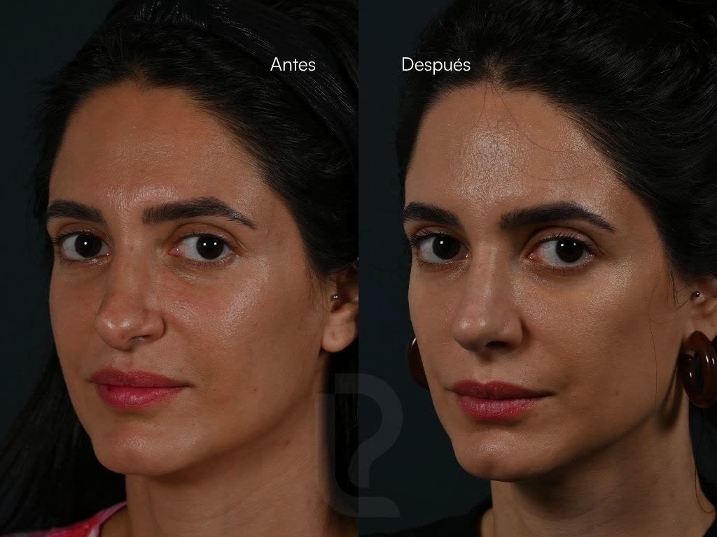 Rinoplastia caso 4