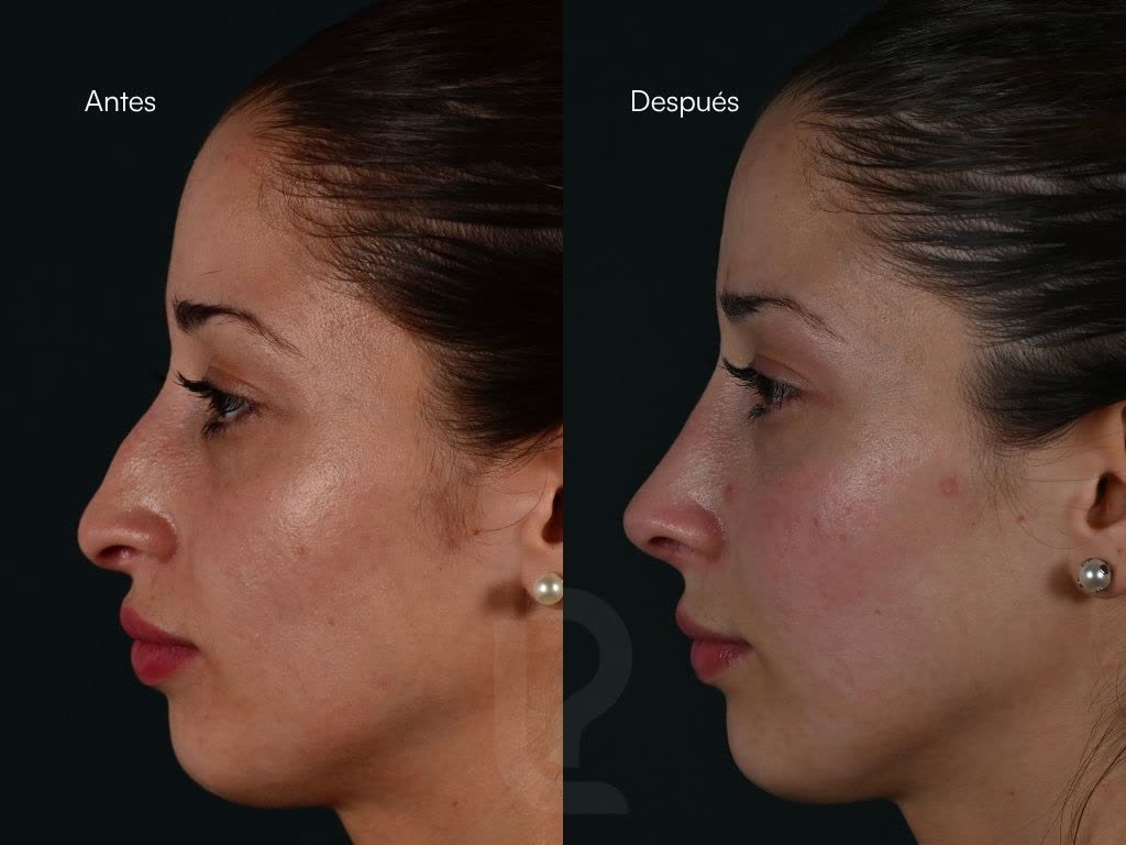 Rinoplastia caso 5