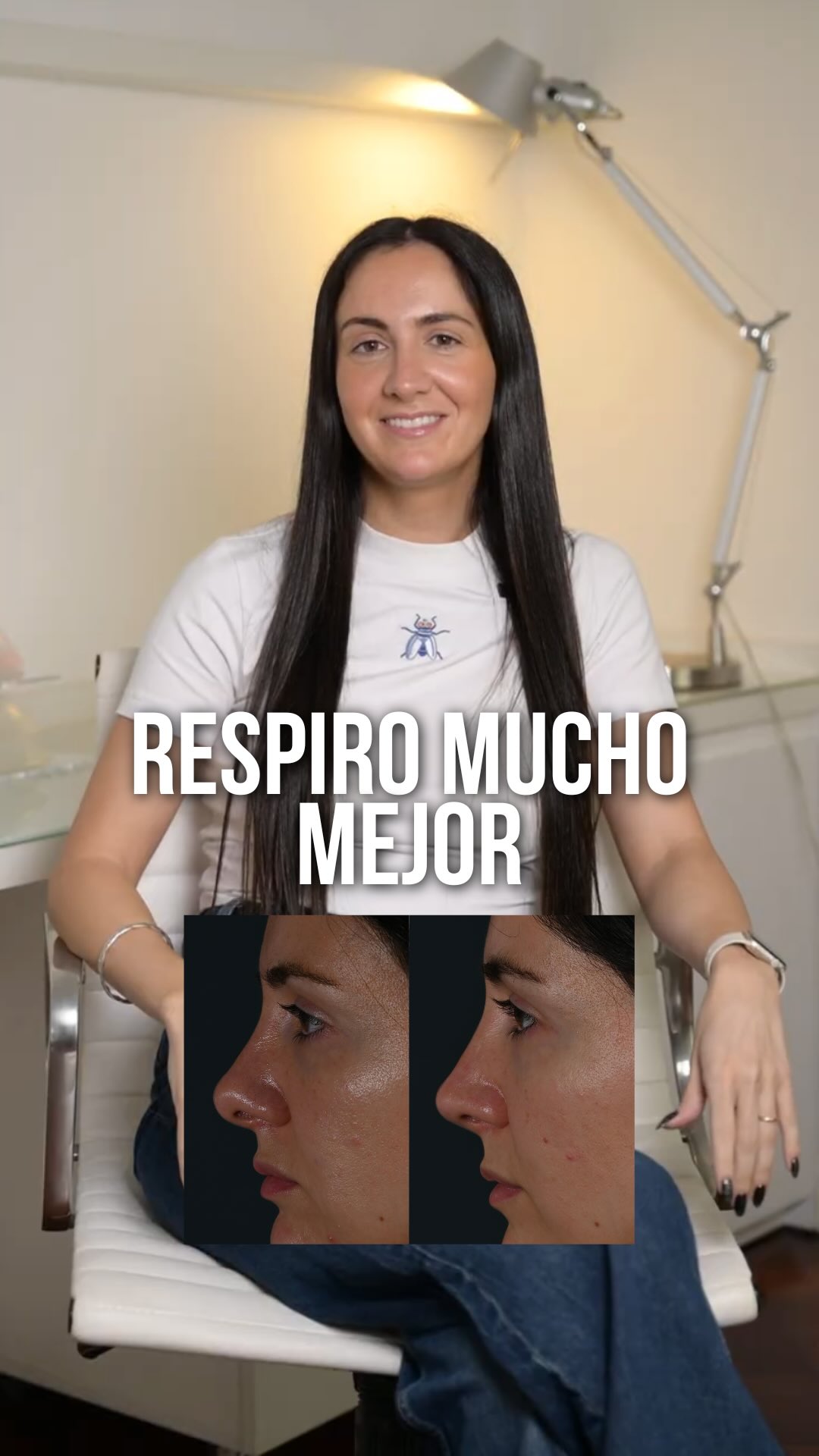 Sofi - Rinoplastia SPE